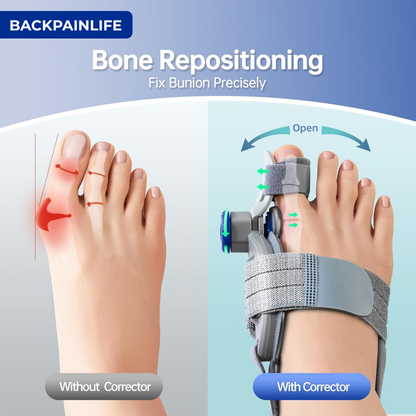 Bonion Toe Corrector