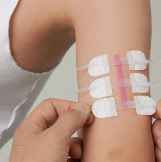 Wound Zippers