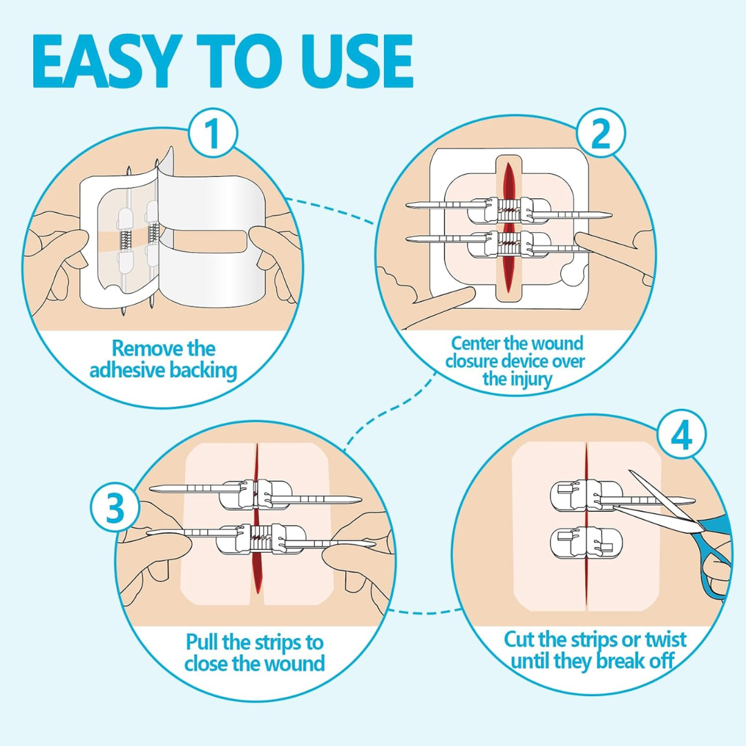 Wound Zippers