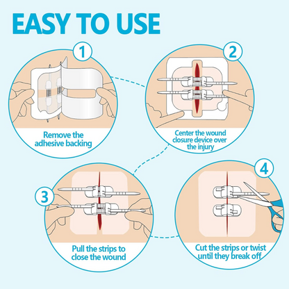 Wound Zippers
